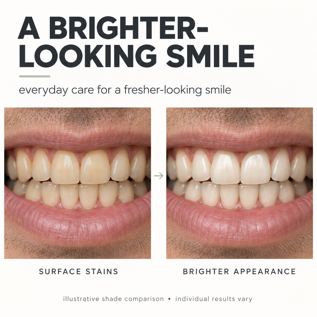 Illustrative comparison showing a brighter looking smile after surface stain care